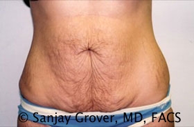 Tummy Tuck Before and After 74 | Sanjay Grover MD FACS