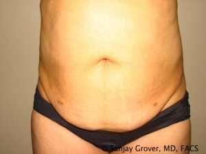 Tummy Tuck Before and After | Grover Aesthetics