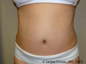 Tummy Tuck Before and After | Grover Aesthetics