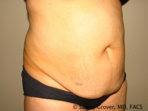 Tummy Tuck Before and After 69 | Sanjay Grover MD FACS