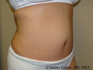 Tummy Tuck Before and After 69 | Sanjay Grover MD FACS