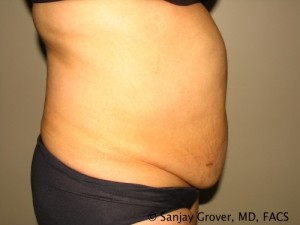 Tummy Tuck Before and After 69 | Grover Aesthetics