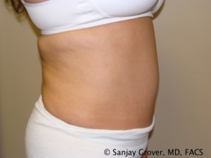 Tummy Tuck Before and After 69 | Grover Aesthetics