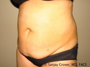 Tummy Tuck Before and After 69 | Grover Aesthetics
