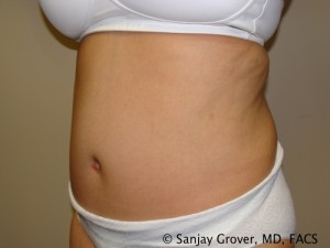 Tummy Tuck Before and After 69 | Grover Aesthetics