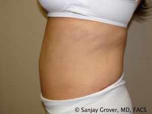 Tummy Tuck Before and After 69 | Grover Aesthetics