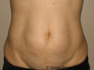 Tummy Tuck Before and After | Grover Aesthetics