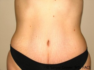 Tummy Tuck Before and After | Grover Aesthetics