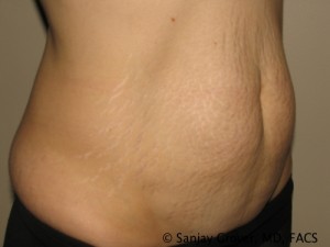 Tummy Tuck Before and After 70 | Grover Aesthetics
