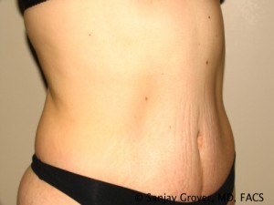Tummy Tuck Before and After 70 | Grover Aesthetics