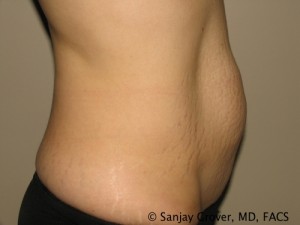 Tummy Tuck Before and After 70 | Grover Aesthetics