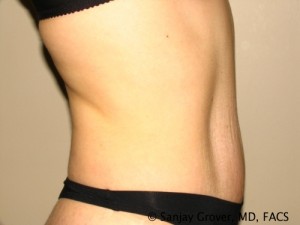 Tummy Tuck Before and After 70 | Grover Aesthetics