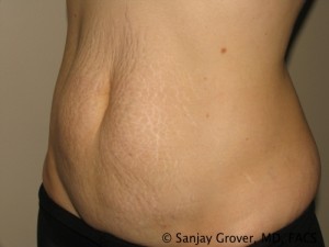 Tummy Tuck Before and After 70 | Grover Aesthetics