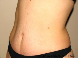 Tummy Tuck Before and After 70 | Grover Aesthetics