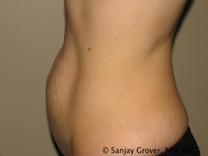 Tummy Tuck Before and After 70 | Grover Aesthetics