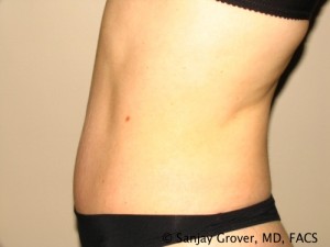 Tummy Tuck Before and After 70 | Grover Aesthetics