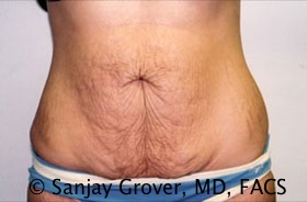 Tummy Tuck Before and After 04 | Sanjay Grover MD FACS