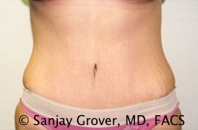 Tummy Tuck Before and After | Grover Aesthetics