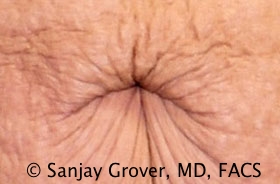 Tummy Tuck Before and After 71 | Grover Aesthetics