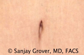 Tummy Tuck Before and After 71 | Grover Aesthetics