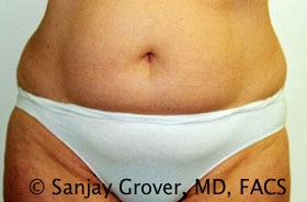 Tummy Tuck Before and After 01 | Sanjay Grover MD FACS