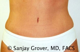 Tummy Tuck Before and After | Grover Aesthetics