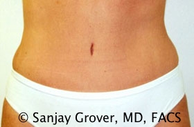 Tummy Tuck Before and After 72 | Sanjay Grover MD FACS