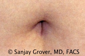 Tummy Tuck Before and After 72 | Sanjay Grover MD FACS