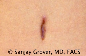 Tummy Tuck Before and After 72 | Grover Aesthetics