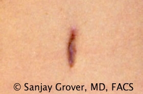 Tummy Tuck Before and After 72 | Sanjay Grover MD FACS