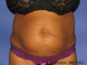 Tummy Tuck Before and After | Grover Aesthetics