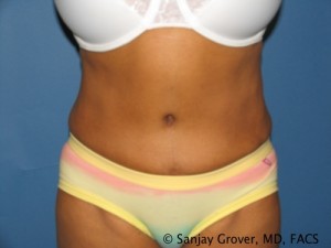 Tummy Tuck Before and After 73 | Sanjay Grover MD FACS