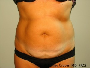 Tummy Tuck Before and After | Grover Aesthetics