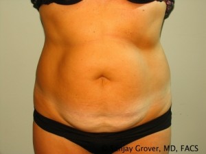 Tummy Tuck Before and After 111 | Sanjay Grover MD FACS