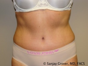 Tummy Tuck Before and After | Grover Aesthetics