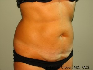 Tummy Tuck Before and After 74 | Grover Aesthetics