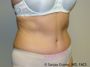 Tummy Tuck Before and After 74 | Grover Aesthetics