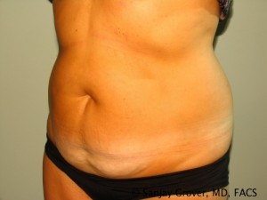 Tummy Tuck Before and After 74 | Grover Aesthetics