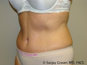 Tummy Tuck Before and After 74 | Grover Aesthetics