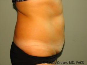 Tummy Tuck Before and After 74 | Grover Aesthetics