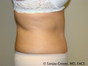 Tummy Tuck Before and After 74 | Grover Aesthetics