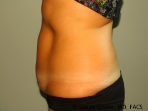 Tummy Tuck Before and After 74 | Grover Aesthetics