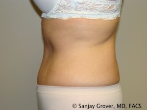 Tummy Tuck Before and After 74 | Grover Aesthetics
