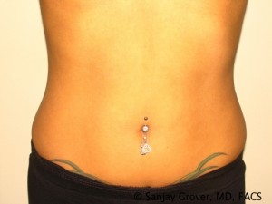 Tummy Tuck Before and After | Grover Aesthetics