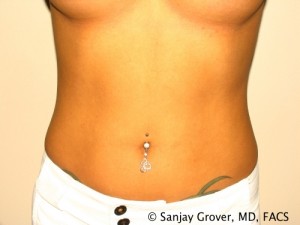 Tummy Tuck Before and After 75 | Sanjay Grover MD FACS