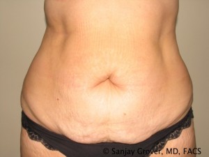Tummy Tuck Before and After | Grover Aesthetics