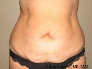 Tummy Tuck Before and After 09 | Sanjay Grover MD FACS