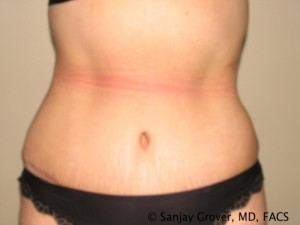 Tummy Tuck Before and After | Grover Aesthetics
