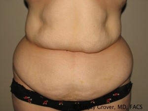 Tummy Tuck Before and After | Grover Aesthetics