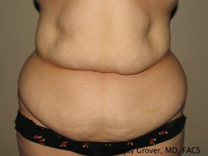 Tummy Tuck Before and After 44 | Sanjay Grover MD FACS